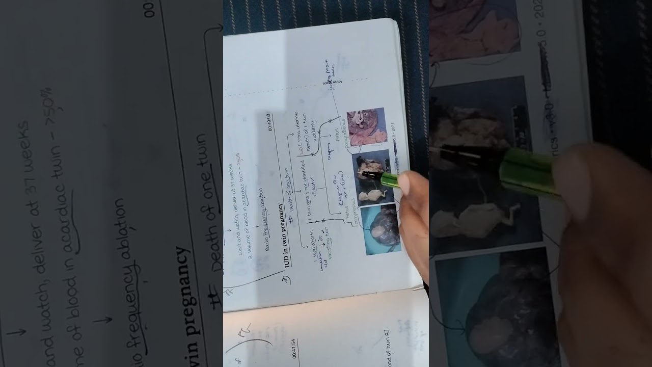 Twin Pregnancy Part-3 ✅OBG Notes Revision 🔥 Neetpg Inicet 