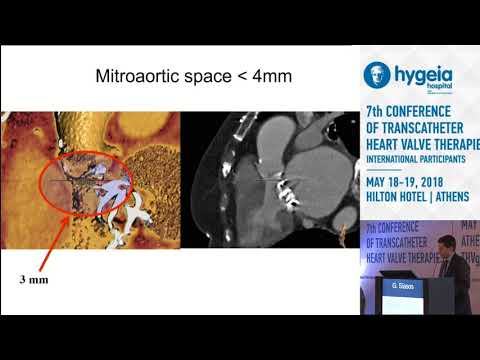 G.Siasos  | My best and worst TAVR case of the year. The single most important lesson learned