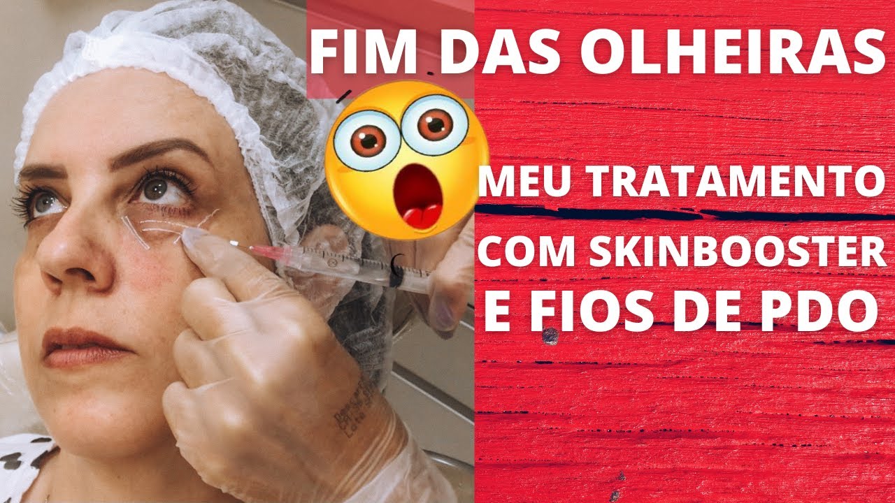 TCHAU OLHEIRAS! TRATAMENTO COM SKINBOOSTER E FIOS DE PDO NA PELE MADURA