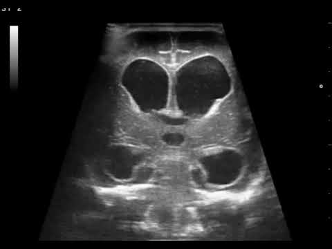 Intraventricular hemorrhage (IVH)