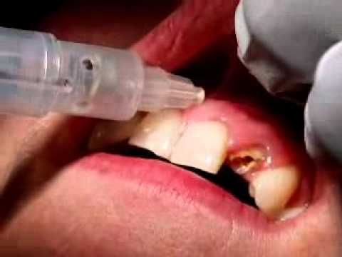 Labial infiltration