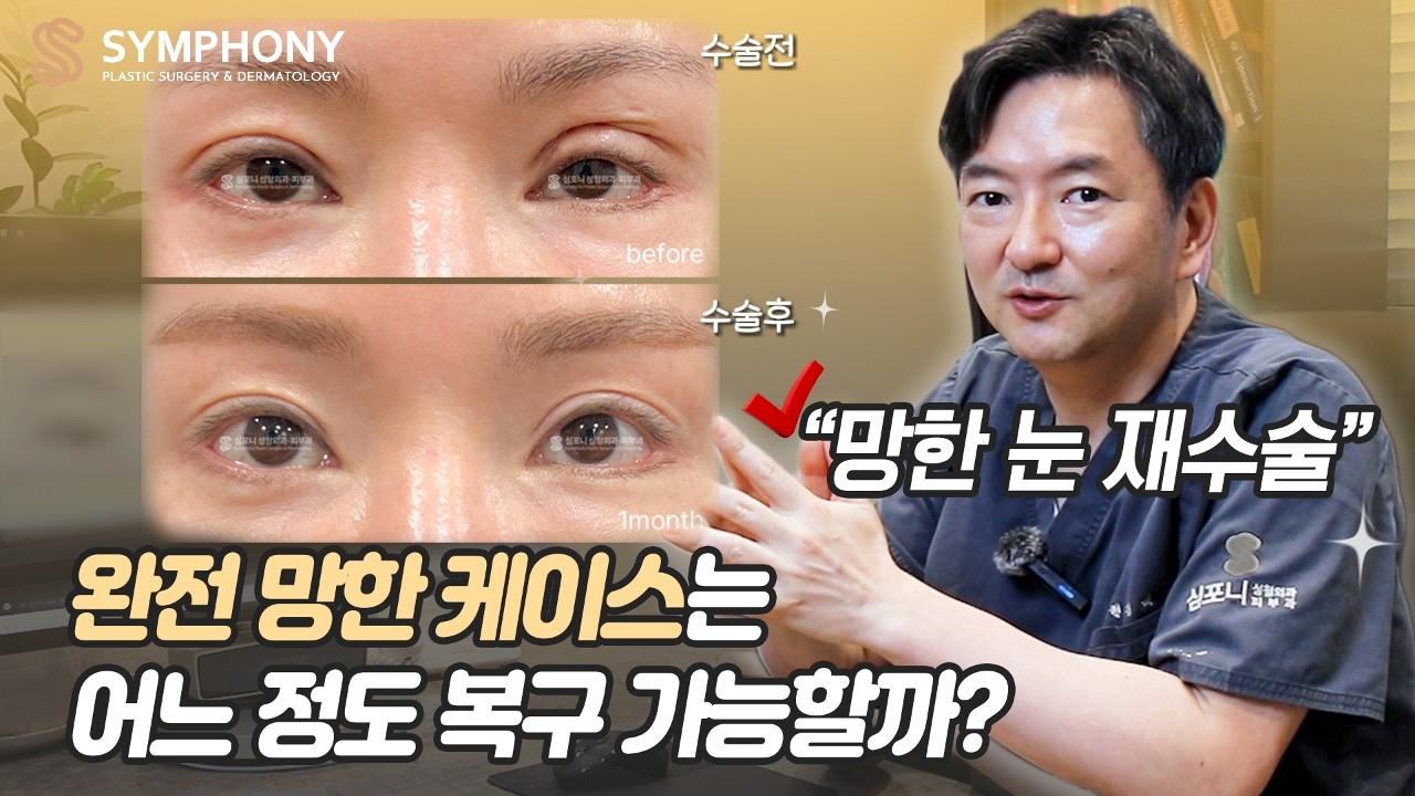 망한 눈재수술 , 1~2개월만에 소세지눈 조기 재수술로 복구 가능할까?