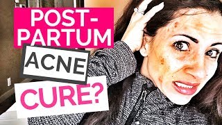 Postpartum Acne | How I Cleared My Acne After Pregnancy