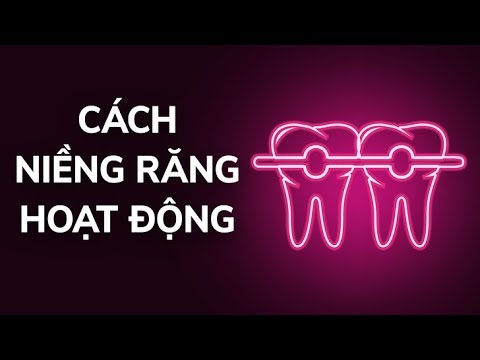 Niềng Răng Hoạt Động Như Thế Nào (Và Sao Lại Mất Thời Gian Thế)