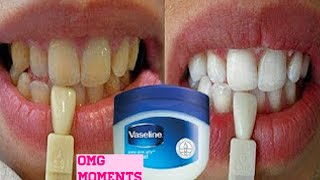 Turn dirty yellow teeth to White in just 3 minutes