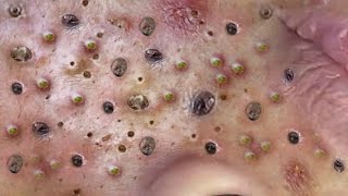 Loan Nguyen Acne Treatment 23n