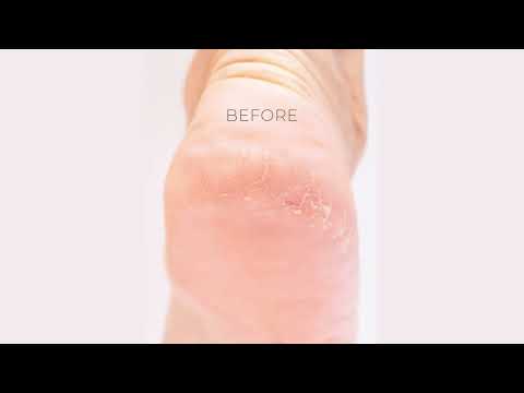 Suche, zniszczone pięty?