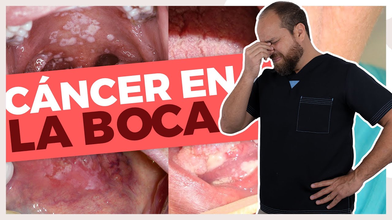 Watch CANCER en la BOCA 😔 ¿Por qué DA / ¿Cómo RECONOCERLO 🚨 Now CANCER en la BOCA 😔 ¿Por qué DA / ¿Cómo RECONOCERLO 🚨