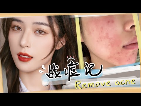 【战痘记】长痘烂脸真是搞我心态！为了战痘拼了！Acne Treatment  [仇仇-qiuqiu] thumnail