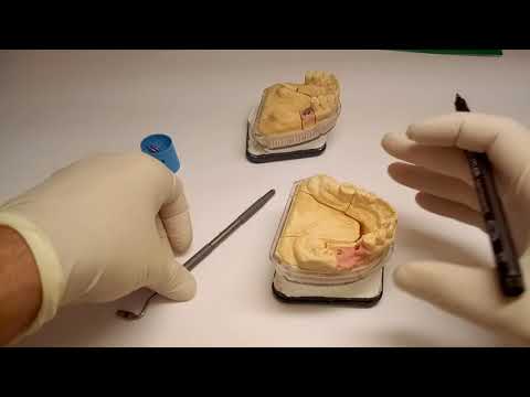 Zahntechnischer Workflow - Bicon: Teil 3 Abutmentauswahl A