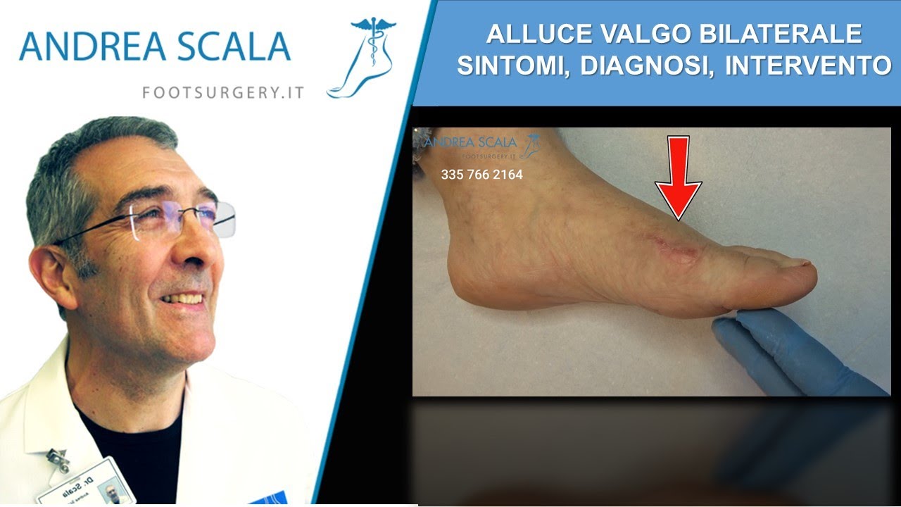 Alluce valgo post intervento | Alluce valgo intervento non riuscito Dott. Andrea Scala