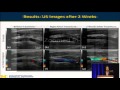 Zhen Xu Noninvasive Thrombolysis Using Microtripsy In A Porcine Deep Vein Thrombosis Model 2016