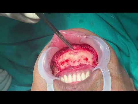 Genioplasty