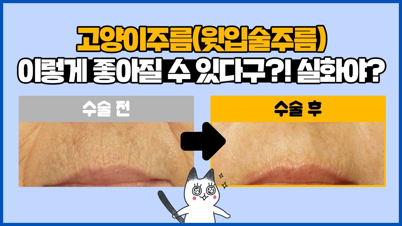 눈, 이마에만 주름 생성?! ❌놉!❌ | 윗입술 에도 생긴다구! | #안면거상술 필러, 보톡스 | 키다리성형…
