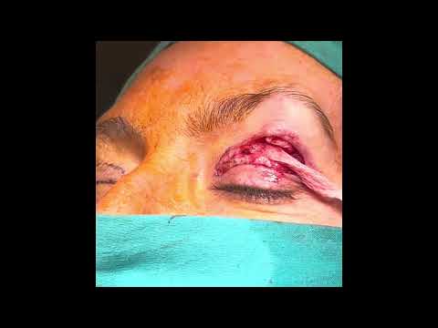 Pexia interna de cejas