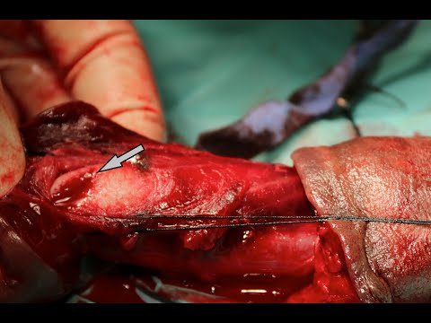 , title : 'Fracture Penis Repair: A Teaching Video with a Live Surgery'