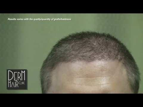 Body hair transplant - My Severe Baldness Cured