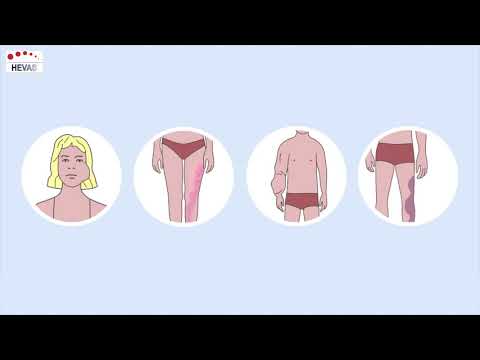 Animation: PIK3ca gene mutation in PROS