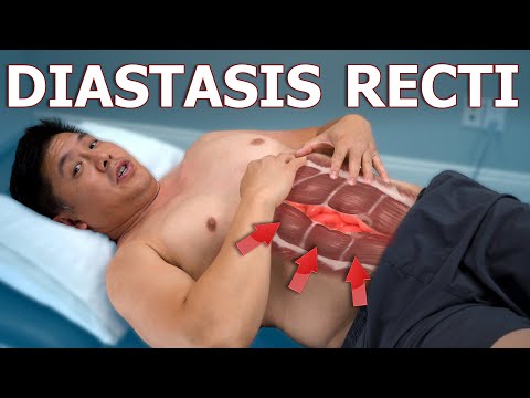 3 Exercises To Reduce Diastasis Recti | Taught By Physical Therapist