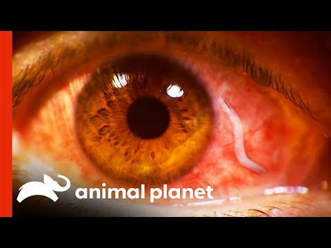 Doctors Remove Huge Parasite From Eyeball | Monsters...