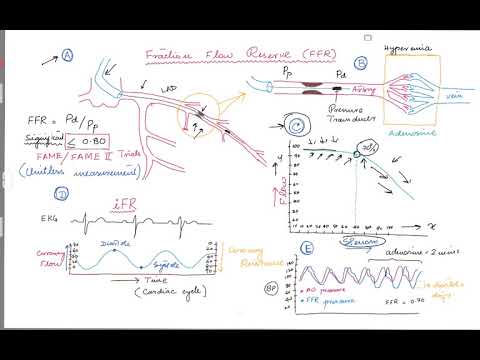 Coronary Angiogram . FFR (Fractional Flow Reserve)