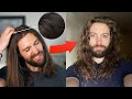 NO MORE SCALP FLAKES Dandruff Vs Dry Scalp Solutions
