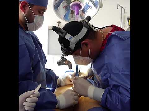 Watch How Penile Surgery in Tijuana Mexico Performed in CER Group