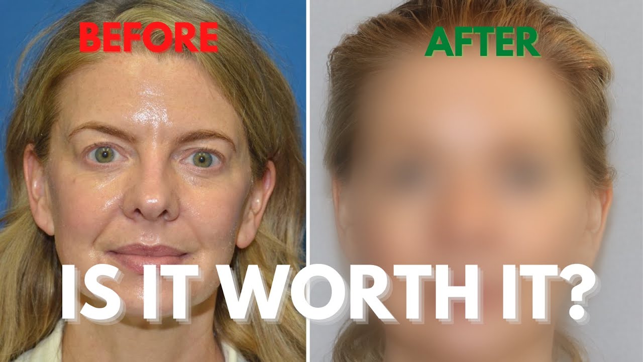 Cool Peel Laser Treatment- WATCH THIS FIRST! Is it worth is Over 50?