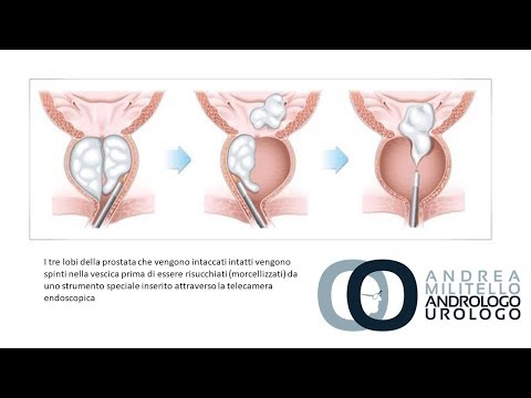 Classificazione di BPH classificazione internazionale delle malattie Recupero di farmaci prostata