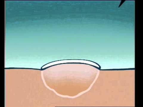 Mikroskopie Analyse der Prostata Prostata-Behandlungsverfahren