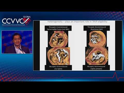 TAVR Indications: Good for All Risks