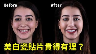 [請益] 請問牙齒貼片可以改善牙齦外露嗎？