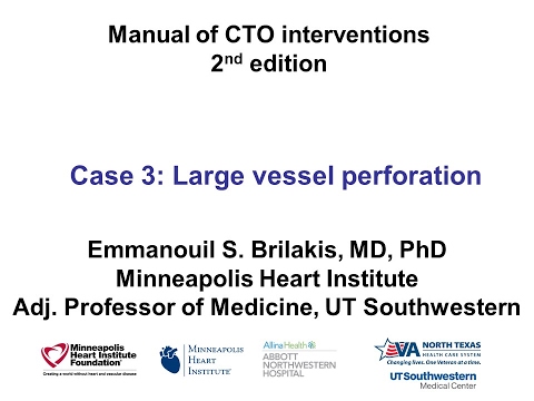 Case 3: Manual of CTO Interventions - Large vessel perforation