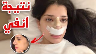 اخيرا نتيجة انفي بعد عملية التجميل.. ????????