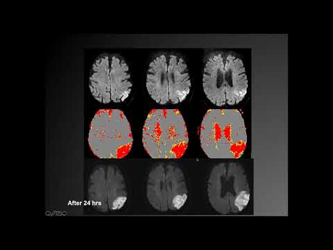 Imaging findings in Acute ischemic stroke