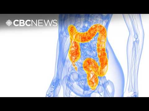 Educational illustration about colon cancer in young people and screening