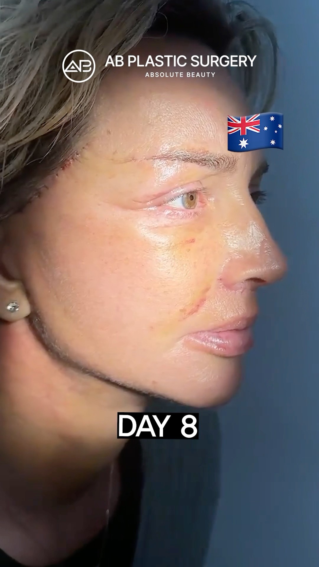 Amazing Facelift Recovery – Just 8 Days Later!