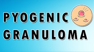 Pyogenic Granuloma Symptoms, Treatment, and Causes