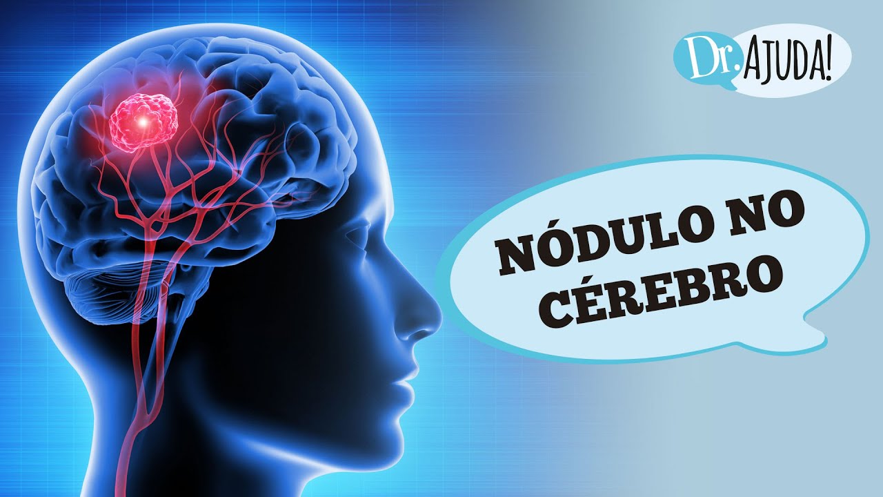 NÓDULO NO CÉREBRO: CÂNCER OU TUMOR BENIGNO? QUAIS OS SINTOMAS?