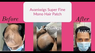 Non surgical hair fixing wigs in delhi