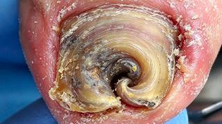 Super Stress Reliever! See Your Toenails Getting Cleaner Step By Step【Xue Yidao】