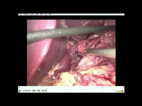 Lapoaroskopowa operacja przepukliny rozworu przełykowego z fundoplikacją Dor'a po rękawowej resekcji żołądka