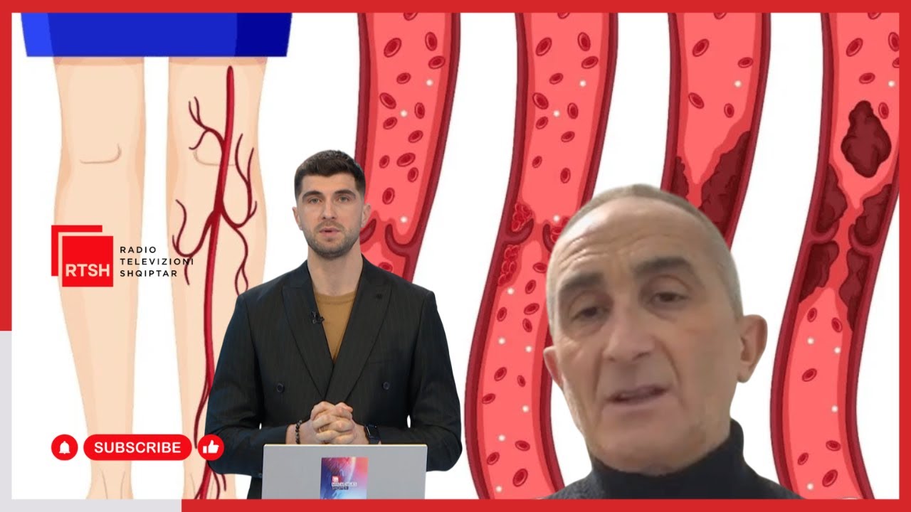 Trombozat, rreziku i heshtur për jetën. Hematologu shpjegon si t’i shmangim dhe t’i diagnostikojmë në kohë