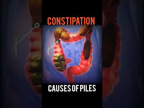 Constipation- Causes Of Piles