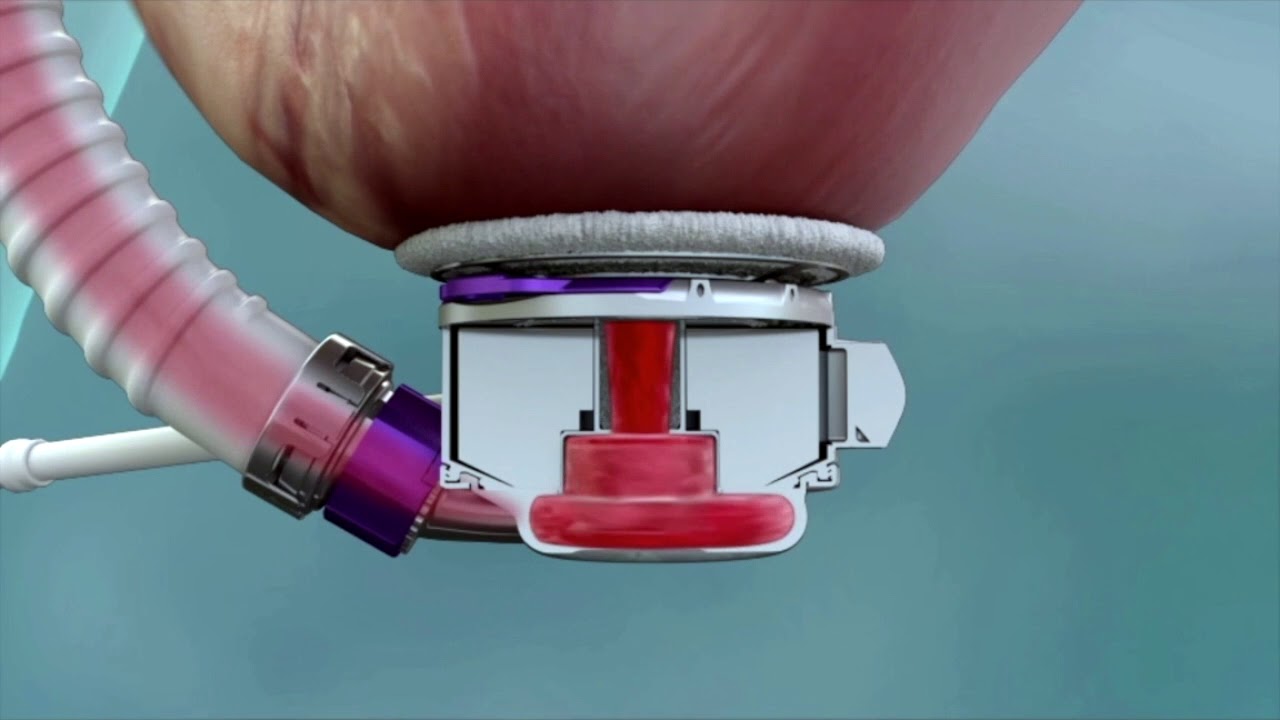 HeartMate 3 Animation