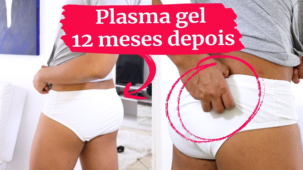 Como está o Preenchimento Autólogo de plasma do meu bumbum DEPOIS de 12 meses