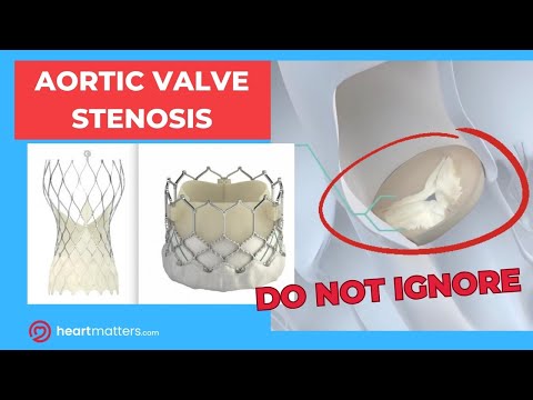 What is Aortic Stenosis? A Focus on Causes, Symptoms and Management.