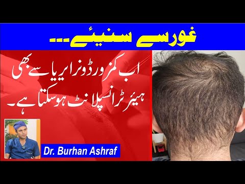 Can You Get a Hair Transplant with a Weak Donor Area?