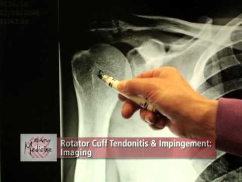 download lagu mp3 mp4 Acromion, download lagu Acromion gratis, unduh video klip Acromion