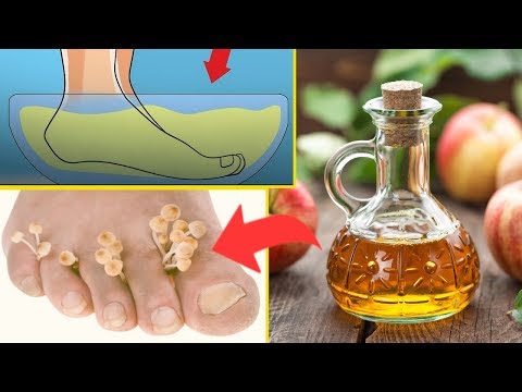 Mocz Stopy W Occie Jabłkowym Raz W Tygodniu — Zobaczysz Co Się Stanie Z Twoim Ciałem